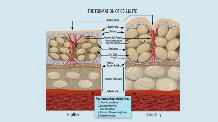 Cellulite causes