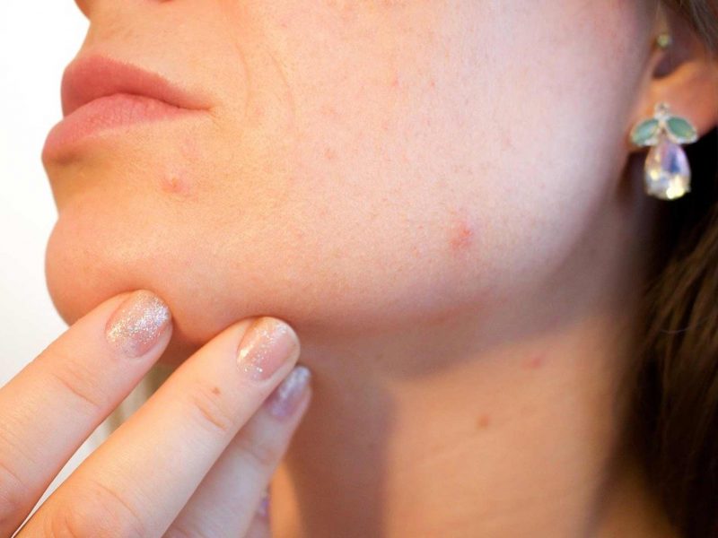 Get rid of spots fast and get rid of blemishes
