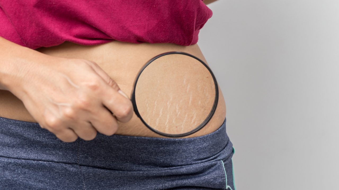 How to get rid of stretch marks and causes