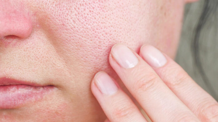 how-to-minimise-pores-and-make-pores-look-smaller