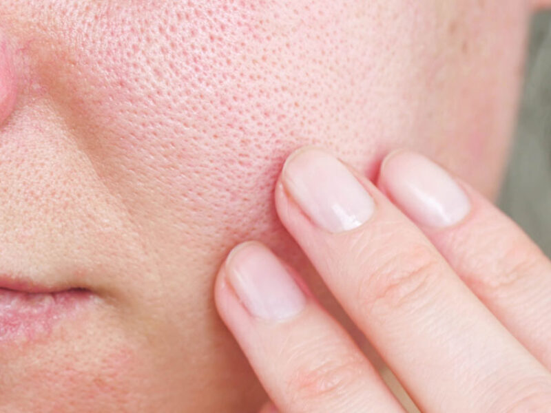 how-to-minimise-pores-and-make-pores-look-smaller