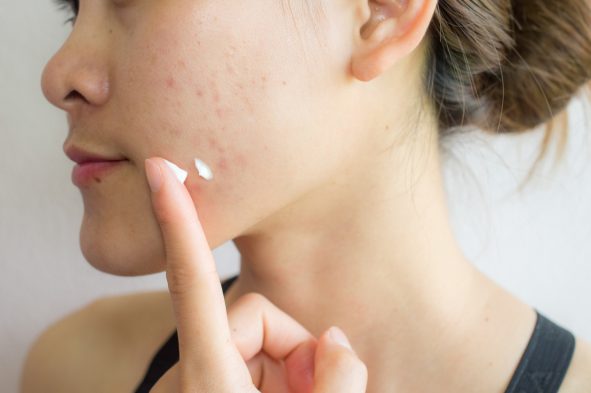 non comedogenic rating to stop breakouts and acne