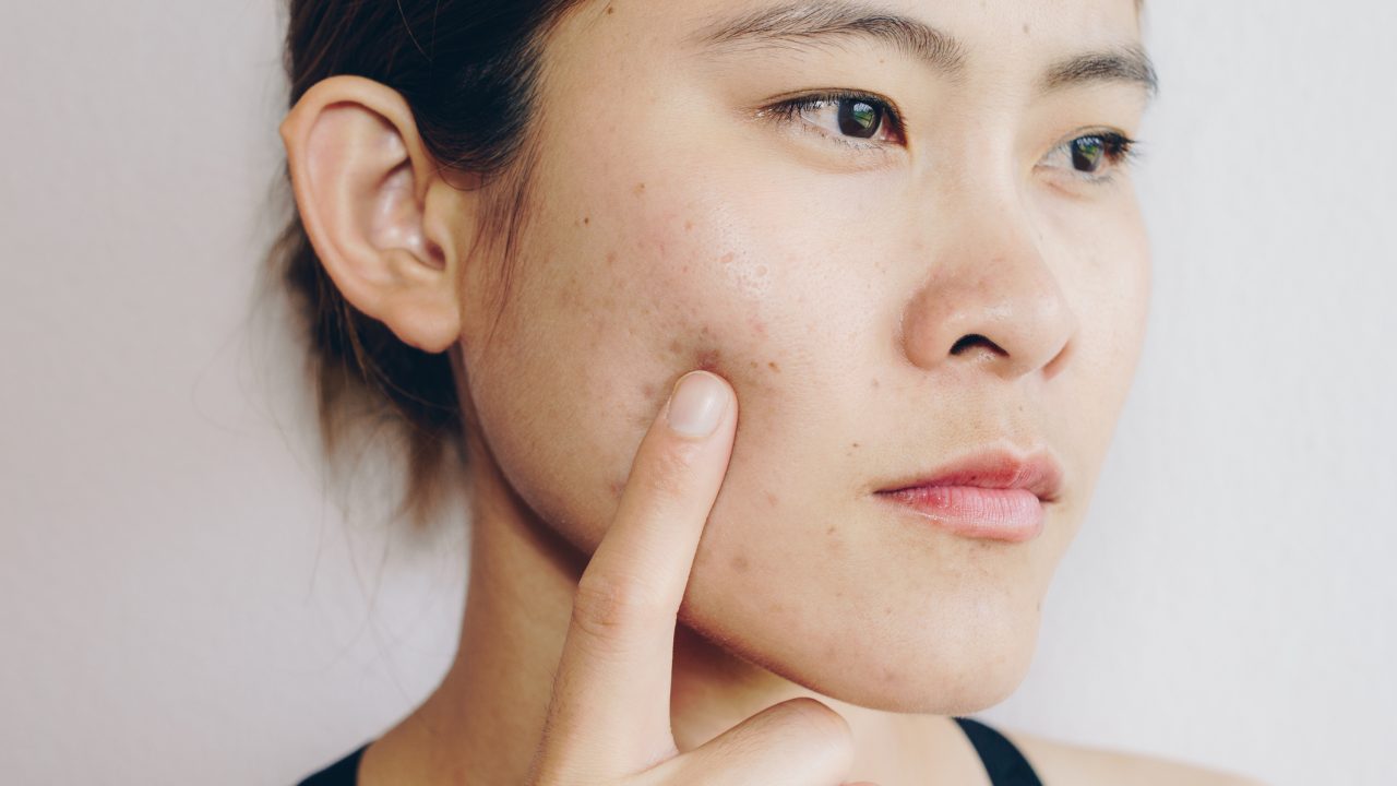 what causes acne and how to get rid of acne