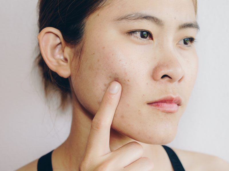what causes acne and how to get rid of acne