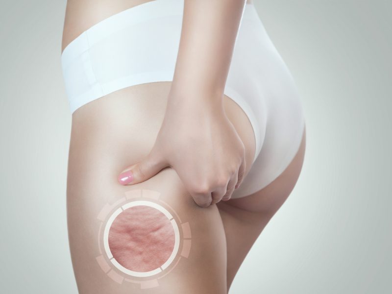 What causes cellulite about how to get rid of cellulite