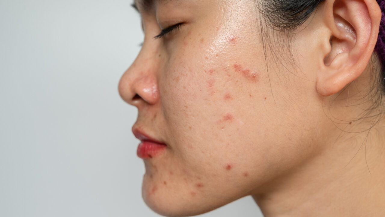 How to get rid of oily skin and stop oily skin causes acne