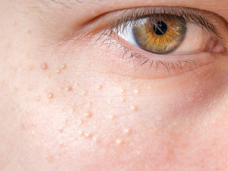What is milia, what causes milia spots and how to get rid of milia
