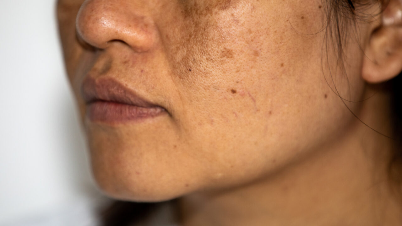 how to get rid of hyperpigmentation