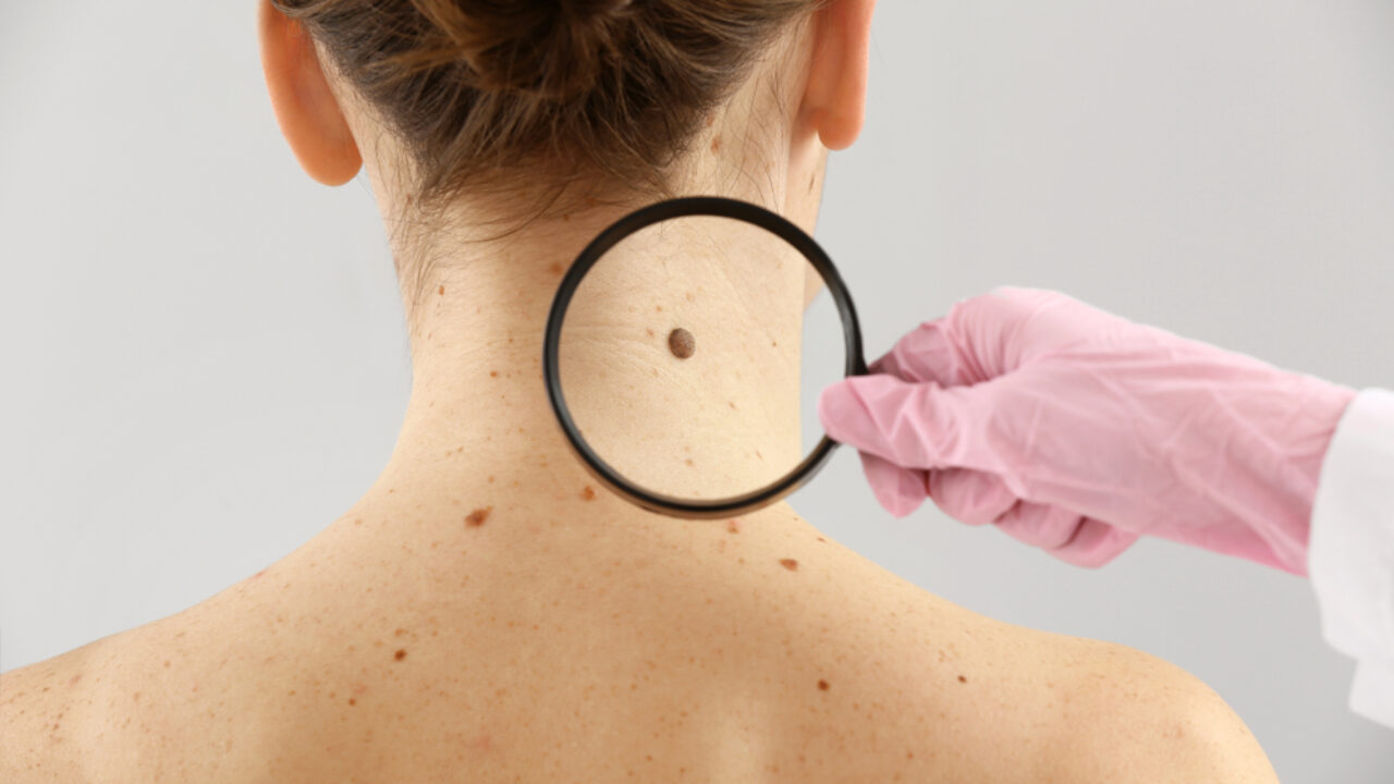 Skin cancer types and how to check for skin cancer