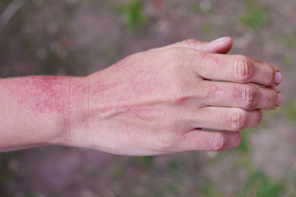 Winter rash on hands and winter itch causes