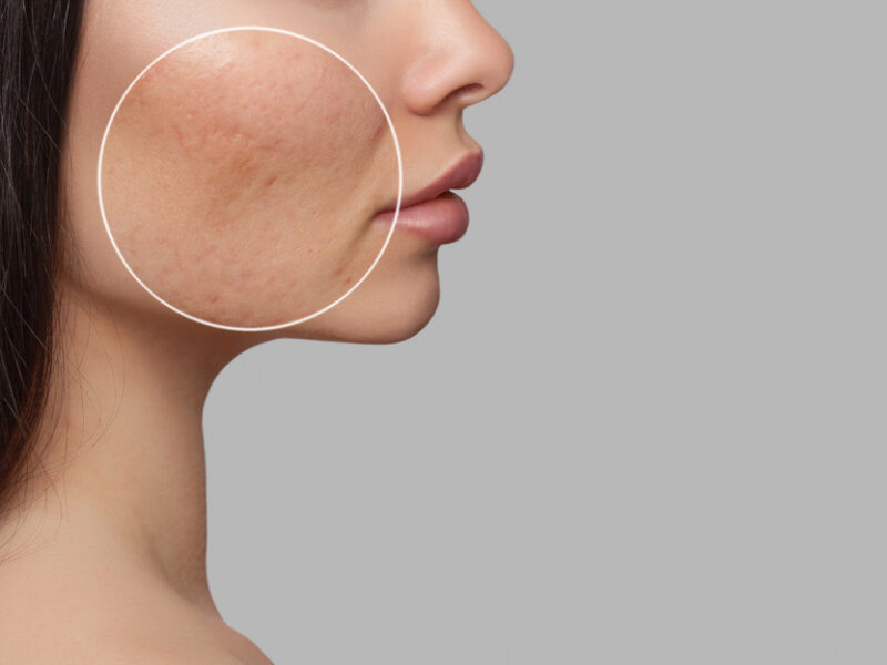 How to get rid of acne scars fast and naturally