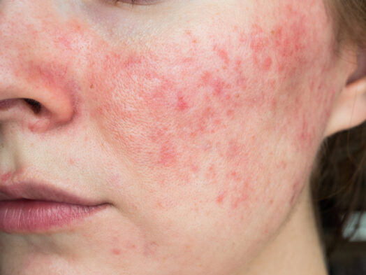 Papulopustular Rosacea triggers and how to get rid of rosacea permanently
