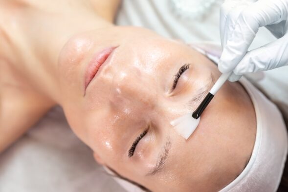 Chemical peels for hyperpigmentation treatment