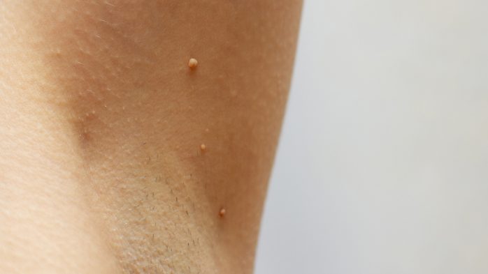 What causes skin tags on armpits bum neck penis