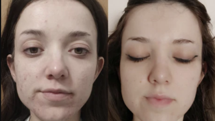 Aegles acne supplement Before and Now