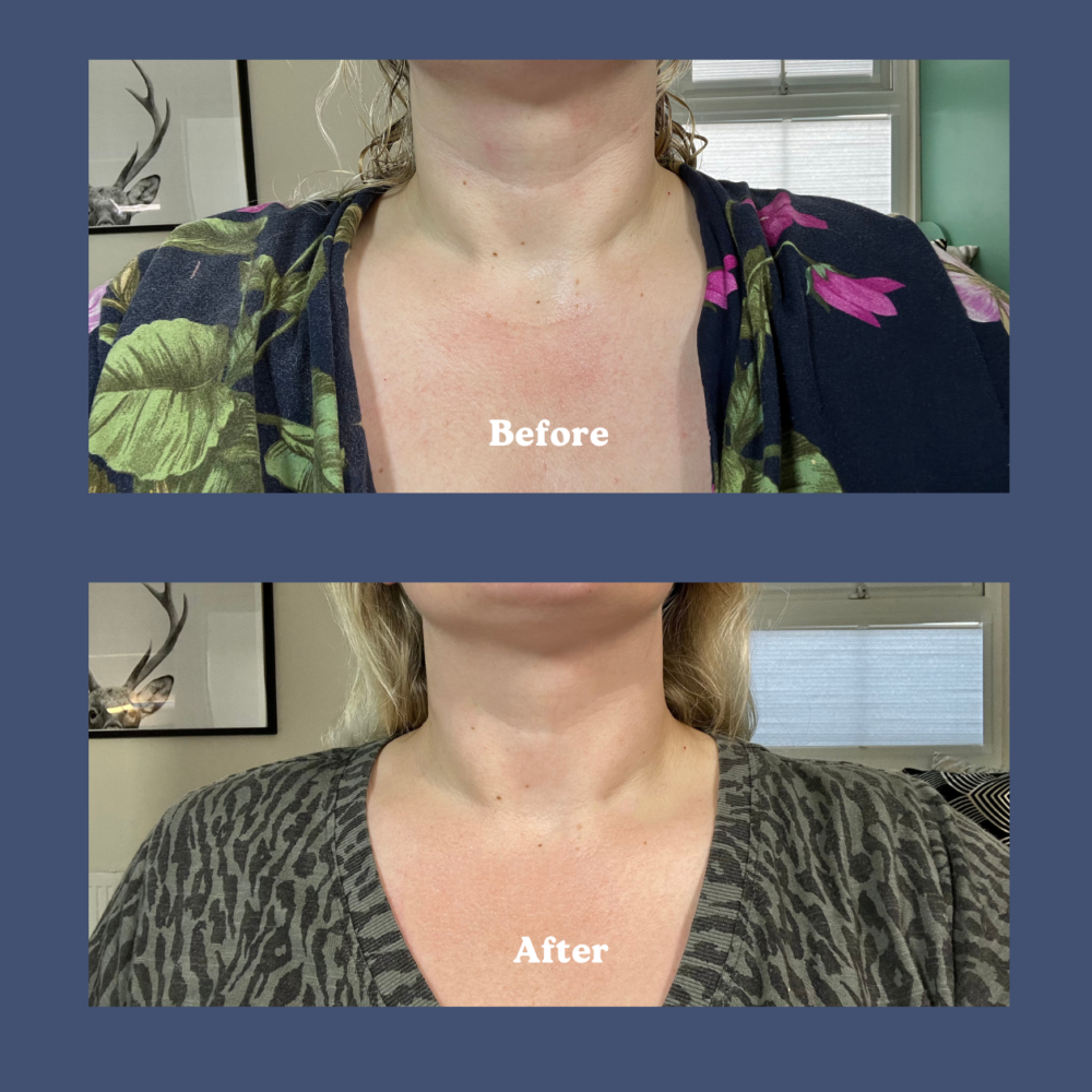 Maelys B-Poised neck cream before and after image