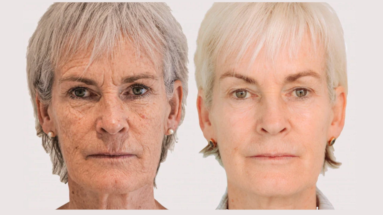 Judy Murray Face Treatment Morpheus8 UK